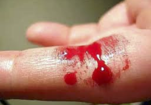 11_bleeding 1 (finger)
