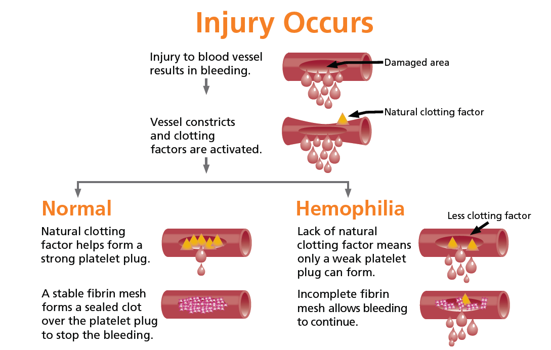 Flow diagram comparing normal response and hemophiliac response to injury. 1. Injury Occurs: Injury to blood vessel results in bleeding then the vessel constricts and clotting factors are activated. 2. In normal conditions, the natural clotting factor helps form a strong platelet plug. A stable fibrin mesh forms a sealed clot over the platelet plug to stop the bleeding. 3. In people with hemophilia, the lack of natural clotting factor means only a weak platelet plug can form. Incomplete fibrin mesh allows bleeding to continue.