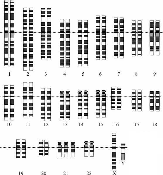 Human karyotype with three copies of chromosome 21, one X, and one Y chromosome.