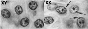 Two images. Left contains somatic cells of an XY individual. Right contains somatic cells of an XX individual with arrows indicating dark spots at the edges of the nuclei.