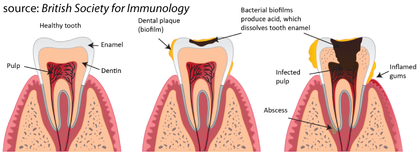 Bacterial biofilms produce acid, which dissolve tooth enamel and can lead to inflamed gums, infected pulp, and abscesses.