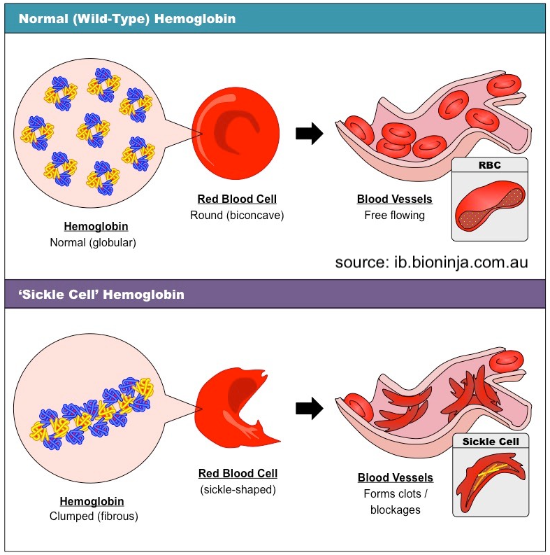 Comparison of normal (globular) versus clumped (fibrous) hemoglobin. Normal hemoglobin allows round (biconcave) red blood cells to flow freely through blood vessels. Clumped hemoglobin produces sickle-shaped red blood cells which can form clots and blockages in blood vessels.
