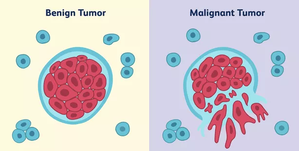 Left, Benign tumor is a mass of red cells with normal blue cells spread out around the tumor. Right, Malignant tumor shows red cells elongating and breaking out of their site of origin.