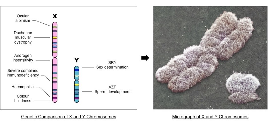 Genetic comparison of X and Y chromosomes on the left. Loci for ocular albinism, Duchenne muscular dystrophy, androgen insensitivity, severe combined immunodeficiency, hemophilia, and color blindness are on the X chromosome. Loci for SRY sex determination and AZF sperm development are on the Y chromosome. A micrograph of X and Y chromosomes is shown on the right. The X chromosome is significantly longer than the Y chromosome. Both have a slightly fuzzy surface appearance.